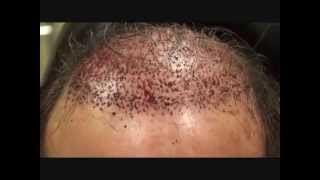 Mens Hair Growth Centers – Immediate Postop FUG