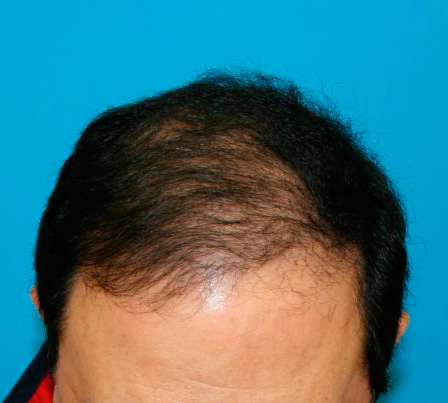 Hair Transplant Surgery After Picture in Cincinnati, Ohio