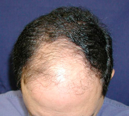 Hair Transplant Surgery Before Picture in Cincinnati, Ohio