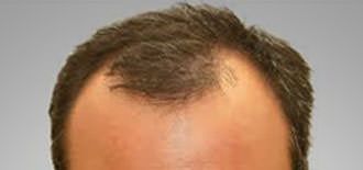 Non-surgical Hair Restoration