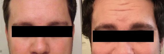 Hair Transplant before and after pictures in Cincinnati, OH, Patient 103