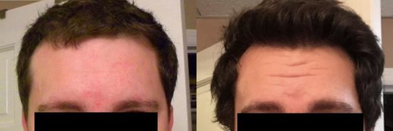 Hair Transplant before and after pictures in Cincinnati, OH, Patient 103