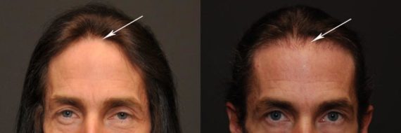 Hair Transplant before and after pictures in Cincinnati, OH, Patient 110