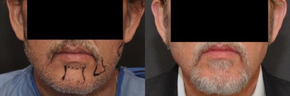 Hair Transplant before and after pictures in Cincinnati, OH, Patient 114