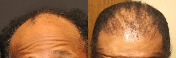 Hair Transplant before and after pictures in Cincinnati, OH, Patient 128