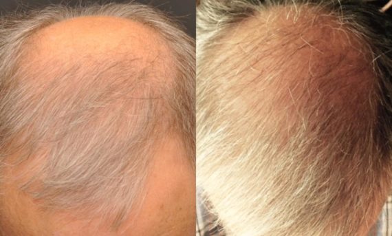 Hair Transplant before and after pictures in Cincinnati, OH, Patient 132