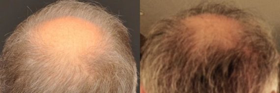 Hair Transplant before and after pictures in Cincinnati, OH, Patient 132