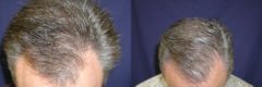 Hair Transplant before and after pictures in Cincinnati, OH, Patient 139