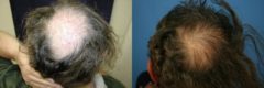 Hair Transplant before and after pictures in Cincinnati, OH, Patient 143