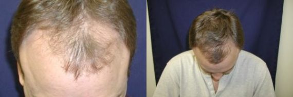 Hair Transplant before and after pictures in Cincinnati, OH, Patient 147