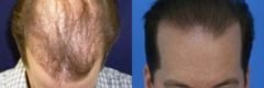 Hair Transplant before and after pictures in Cincinnati, OH, Patient 151