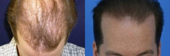 Hair Transplant before and after pictures in Cincinnati, OH, Patient 151