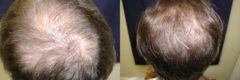 Hair Transplant before and after pictures in Cincinnati, OH, Patient 155