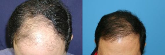 Hair Transplant before and after pictures in Cincinnati, OH, Patient 159