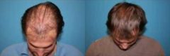 Hair Transplant before and after pictures in Cincinnati, OH, Patient 163