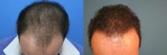 Hair Transplant before and after pictures in Cincinnati, OH, Patient 167