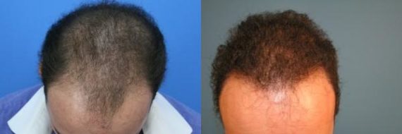 Hair Transplant before and after pictures in Cincinnati, OH, Patient 167