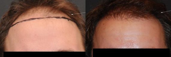 Hair Transplant before and after pictures in Cincinnati, OH, Patient 64