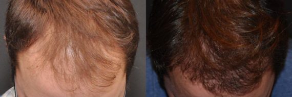 Hair Transplant before and after pictures in Cincinnati, OH, Patient 64