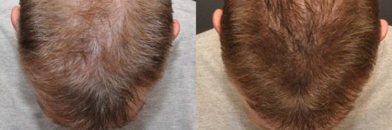 Hair Transplant before and after pictures in Cincinnati, OH, Patient 85