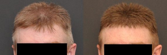 Hair Transplant before and after pictures in Cincinnati, OH, Patient 85