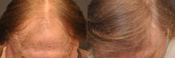 Hair Transplant before and after pictures in Cincinnati, OH, Patient 92