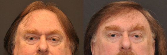 Hair Transplant before and after pictures in Cincinnati, OH, Patient 92