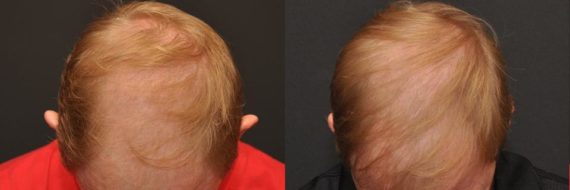 Hair Transplant before and after pictures in Cincinnati, OH, Patient 99