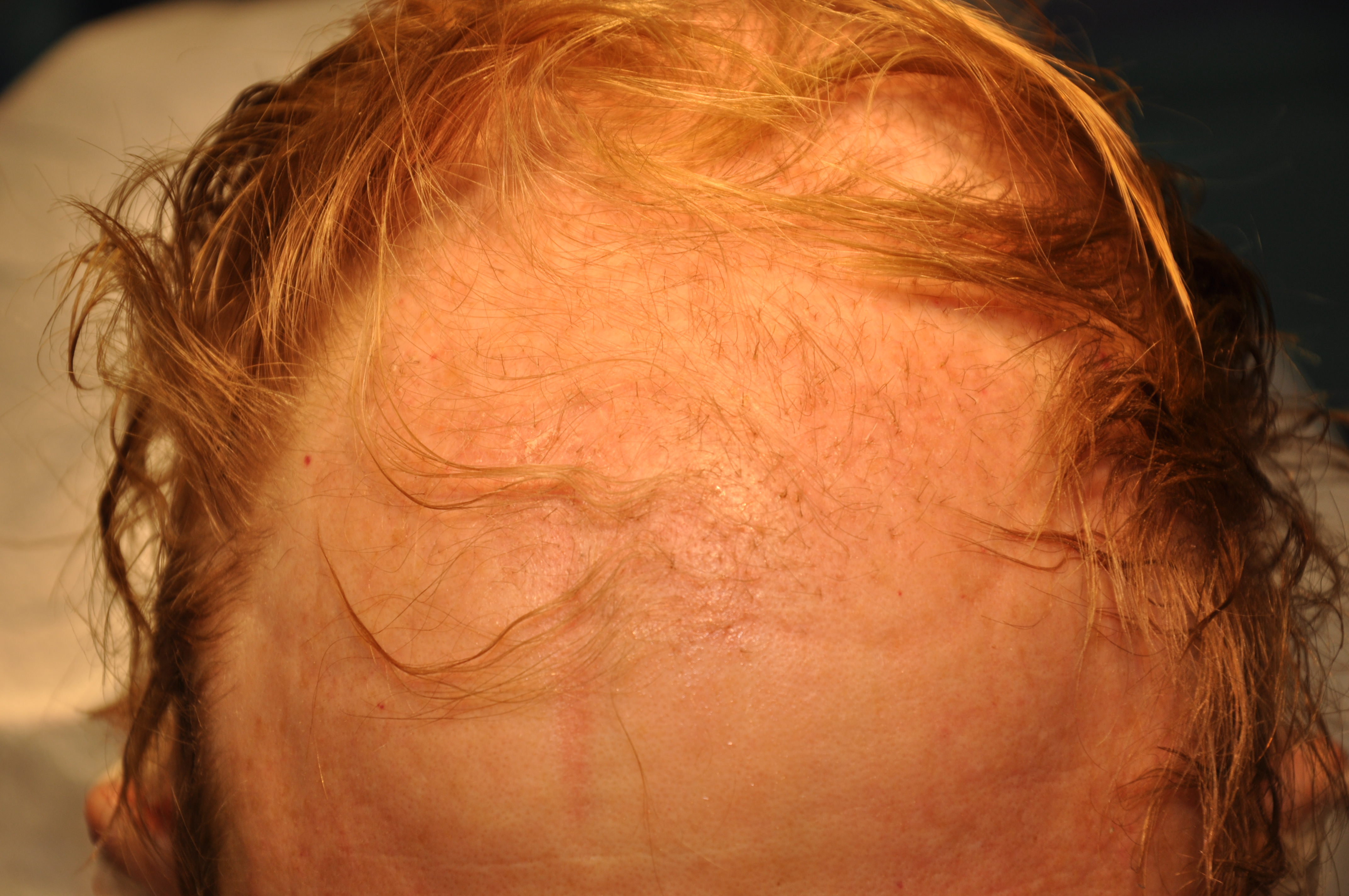 Post Hair Transplant: Two weeks