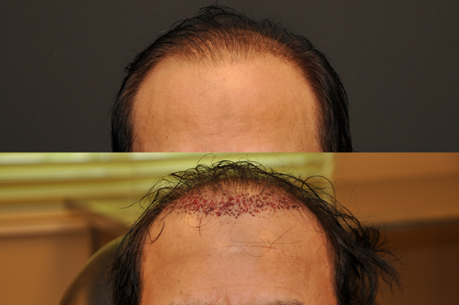 Secondary Hair Transplants: Correcting and Improving Results