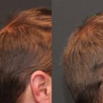 Hair Transplant, Dr. Donath, Cincinnati