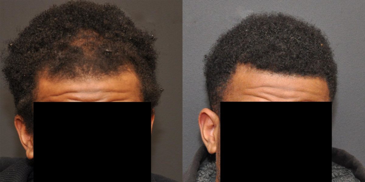 Hair Transplant before and after pictures in Cincinnati, OH, Patient 457