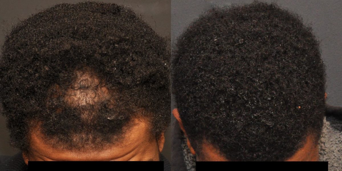 Hair Transplant before and after pictures in Cincinnati, OH, Patient 457